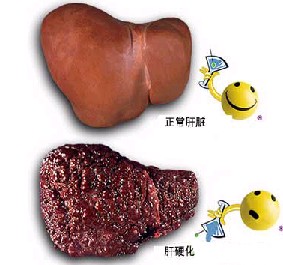早期肝硬化的症状有哪些