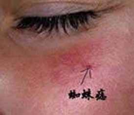 征服丙肝 让我重现美丽