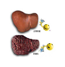肝硬化能治好不能
